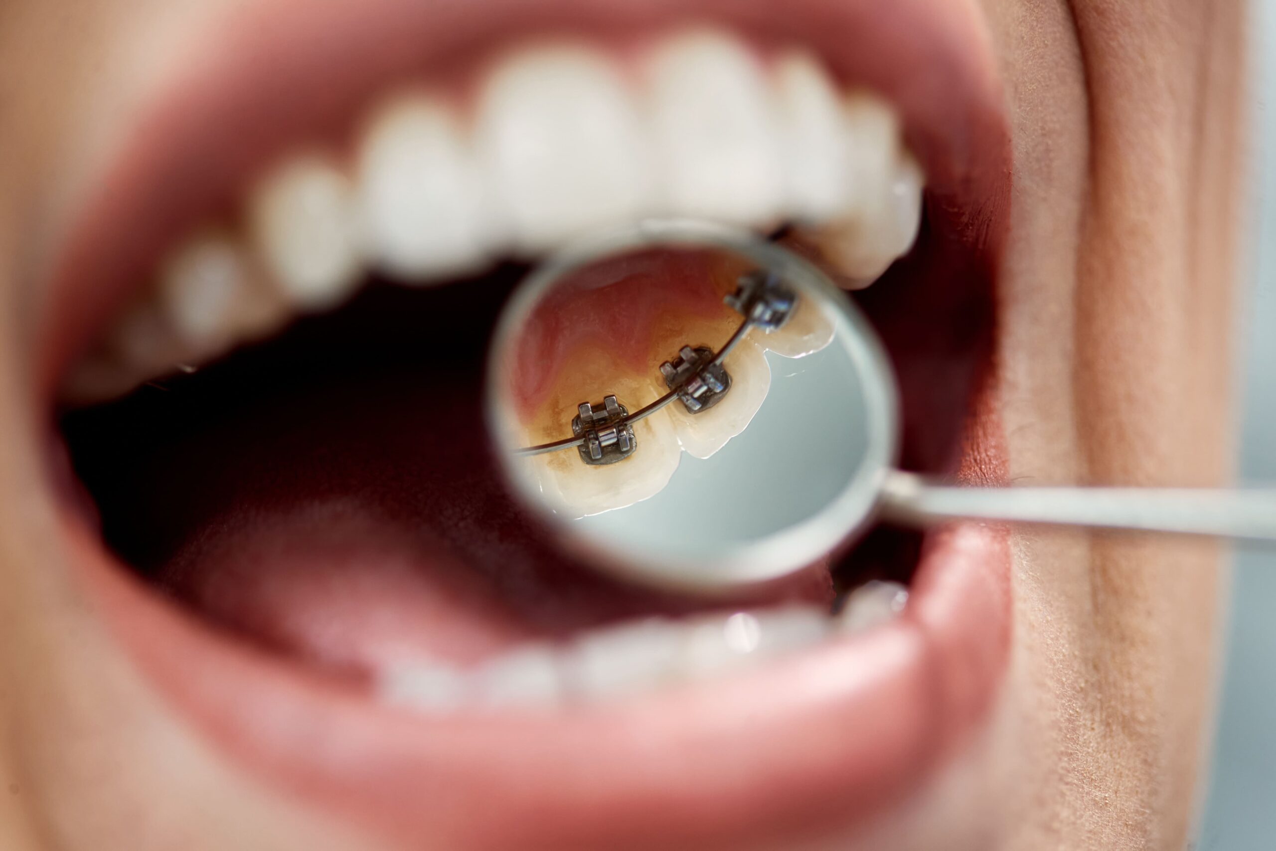 lingual braces behind the teeth